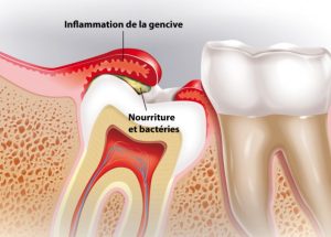 Quelle est l'évolution des dents de sagesse ?
