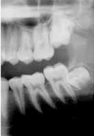 Quelle est l'évolution des dents de sagesse ?