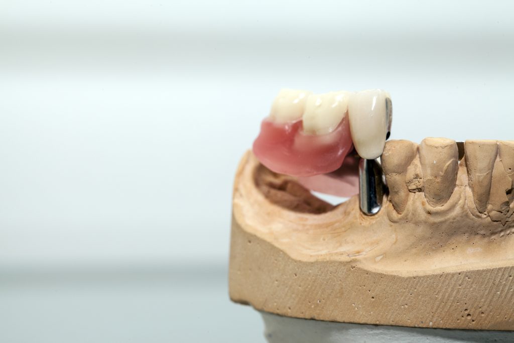UN IMPLANT POUR REMPLACER UNE DENT
